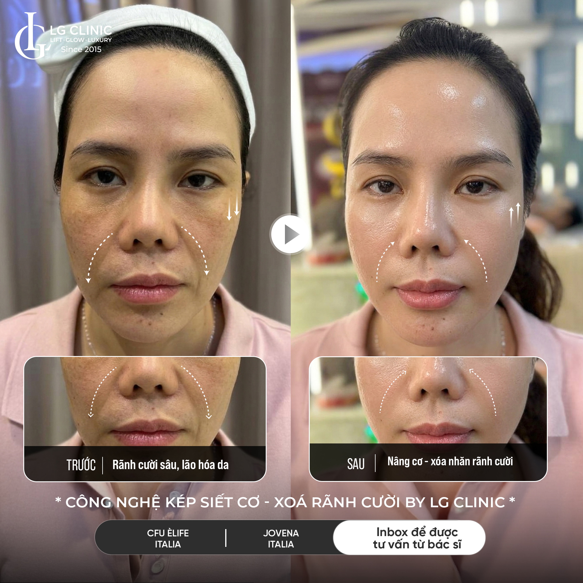 Xóa rãnh cười vĩnh viễn được không? Khám phá công nghệ kép hiệu quả bền vững đang được săn lùng tại LG Clinic