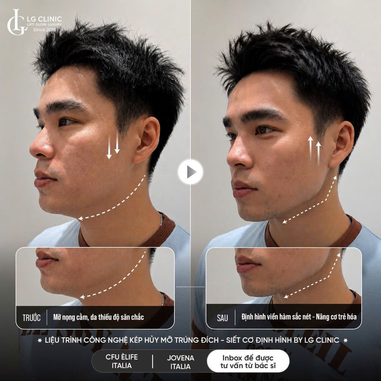3 Công  nghệ kép tại LG Clinic còn mang lại hiệu quả định hình viền hàm sắc nét